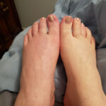 two bare feet, the left one is red and swollen.